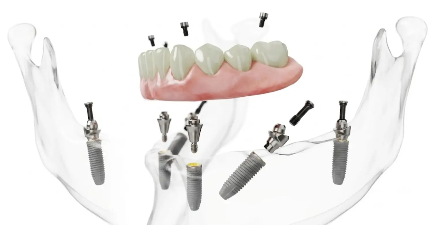 Nobel Implants 2